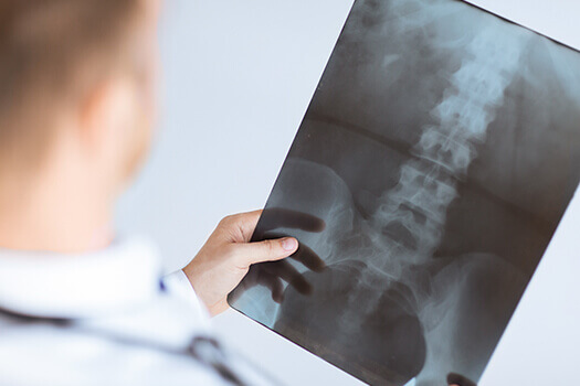 what-influences-returning-to-work-after-spine-surgery